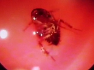 އިންޑިއާ އަންހެނެއްގެ ބޮލުތެރެއިން ދިރޭ ކުރަތްޕެއް ޑޮކްޓަރުން ނަގައިފި