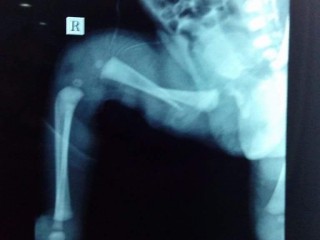 IGMH probes infant bone injury case 