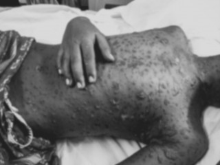 ބޭނުންކުރި ބޭހެއްގެ ސަބަބުން 7 އަހަރުގެ ކުއްޖެއްގެ ހަށިގަނޑުގައި ހުސް ފޮޅު! 