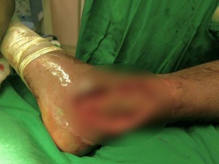 އަލަމްގެ ފައި: ފައިގަ އެޅި ޕްލާސްޓަރުގަނޑު ނެގިއިރު އޮތީ ނުރައްކާތެރި ހާލަތެއްގައި