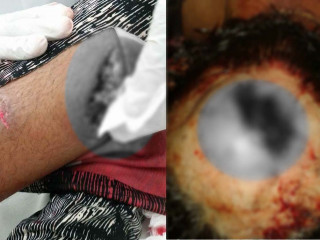 އެކްސިޑެންޓްވި މީހާގެ ބޯ ފަޅައިގެން ގޮސް، ފައިގެ ކުޑަކަޅުވާއާ ދިމާލުން ކަފައިގެން ގޮސްފައި