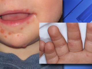 A child displaying symptoms of hand, foot, and mouth disease