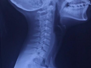 ޕިން އަނގަޔަށް ނުލާ! ހިތާމަވެރި ހާދިސާތައް ގިނަވަނީ!