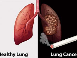 ސިނގިރޭޓްގެ ސަބަބުން ފުއްޕާމެއަށް ކެންސަރު ޖެހުމުގެ ފުރުސަތު ވަރަށް ބޮޑު