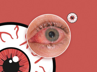 Some of the symptoms of conjunctivitis include fever, eye irritation, watery eyes, eye discharge, and redness of the eye.