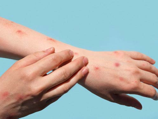 An individual affected by chickenpox, showcasing the telltale red spots of this highly contagious viral infection