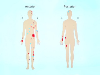 ADK Hospital publicizes a diagram showing the extent of Nasheed's injuries following Thursday's blast