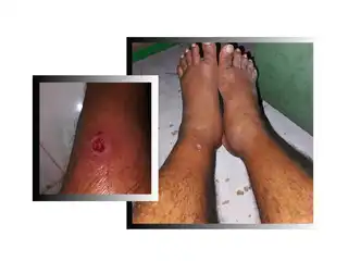 މާފުށީ ޖަލުގައި ހުރި ގައިދީއަކަށް ބޭސް ފަރުވާގެ ޚިދުމަތް ނުލިބި ބަލި ބޮޑުވަނީ