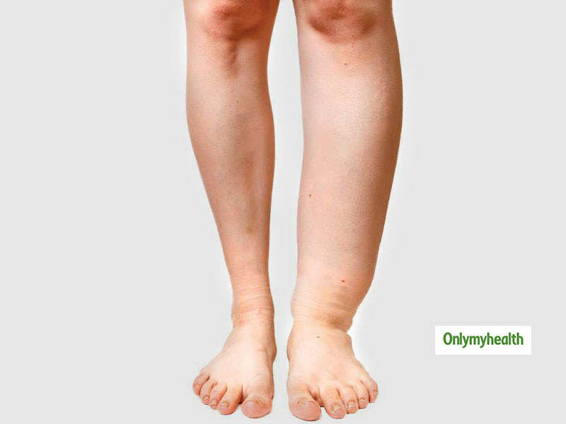 ފައިލޭރިއާ ޖެހިފައިވާ މީހެއްގެ ފައި