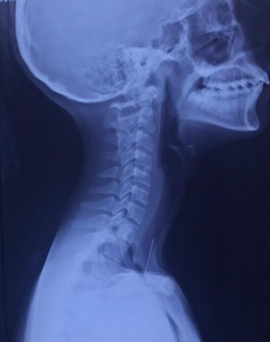 ޕިން ކަރުތެރެއަށް ގޮސްގެން ފަރުވާދީފައި ވަނީ ޒުވާން އުމުރުފުރައިގެ އަންހެނުންނަށް