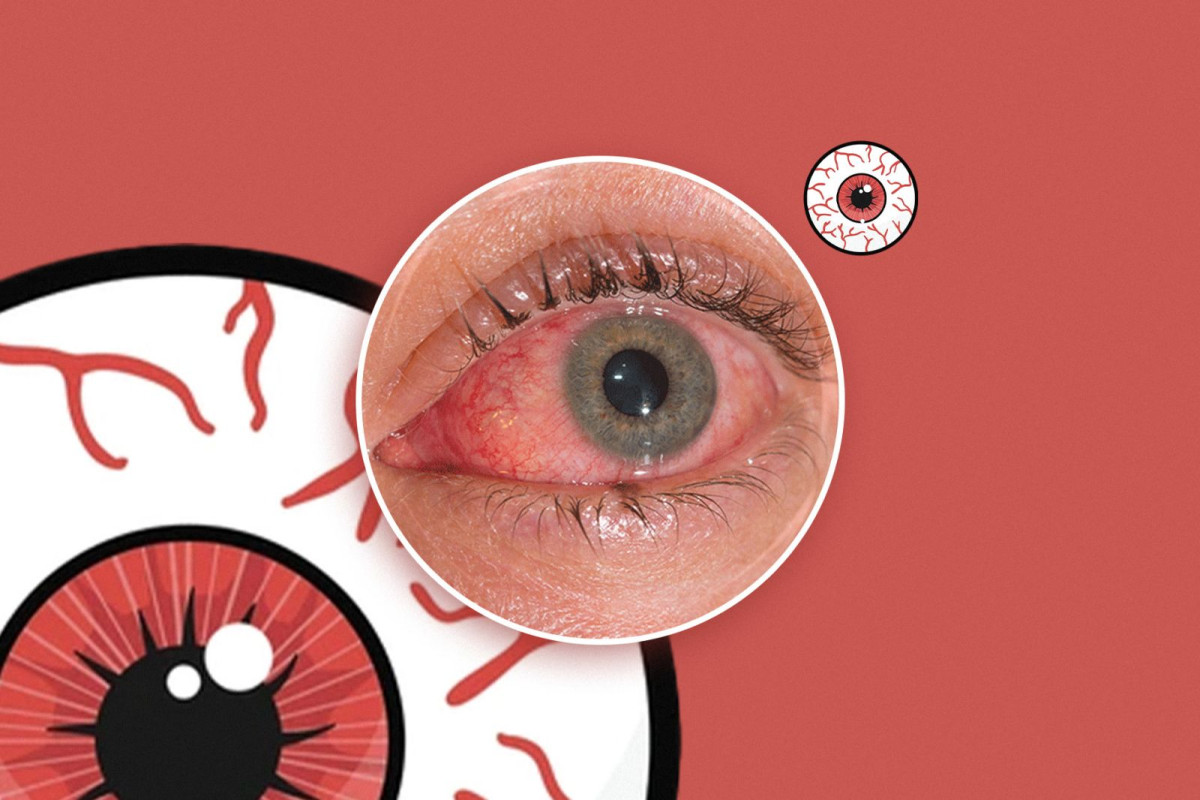Some of the symptoms of conjunctivitis include fever, eye irritation, watery eyes, eye discharge, and redness of the eye.