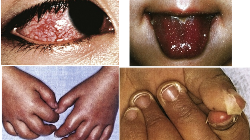 މަލްޓި ސިސްޓަމް އިންފްލެމޭޓްރީ ސިންޑްރަމް