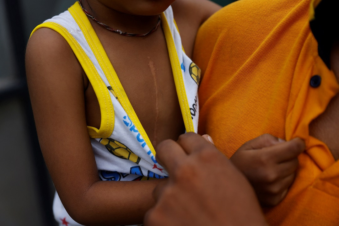 ކެންސަރު ބައްޔަށް ފަރުވާހޯދަމުންދާ އުމުރުން އެންމެ 4 އަހަރުގެ ކުއްޖަކު ކޮށްފައިވާ ސަރޖަރީއެއްގެ ނިޝާން - ފޮޓޯ: ރޮއިޓަރސް 