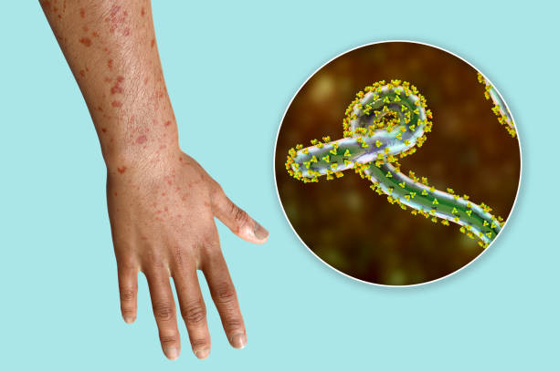 މާބާރގް ވައިރަސް ބަލި