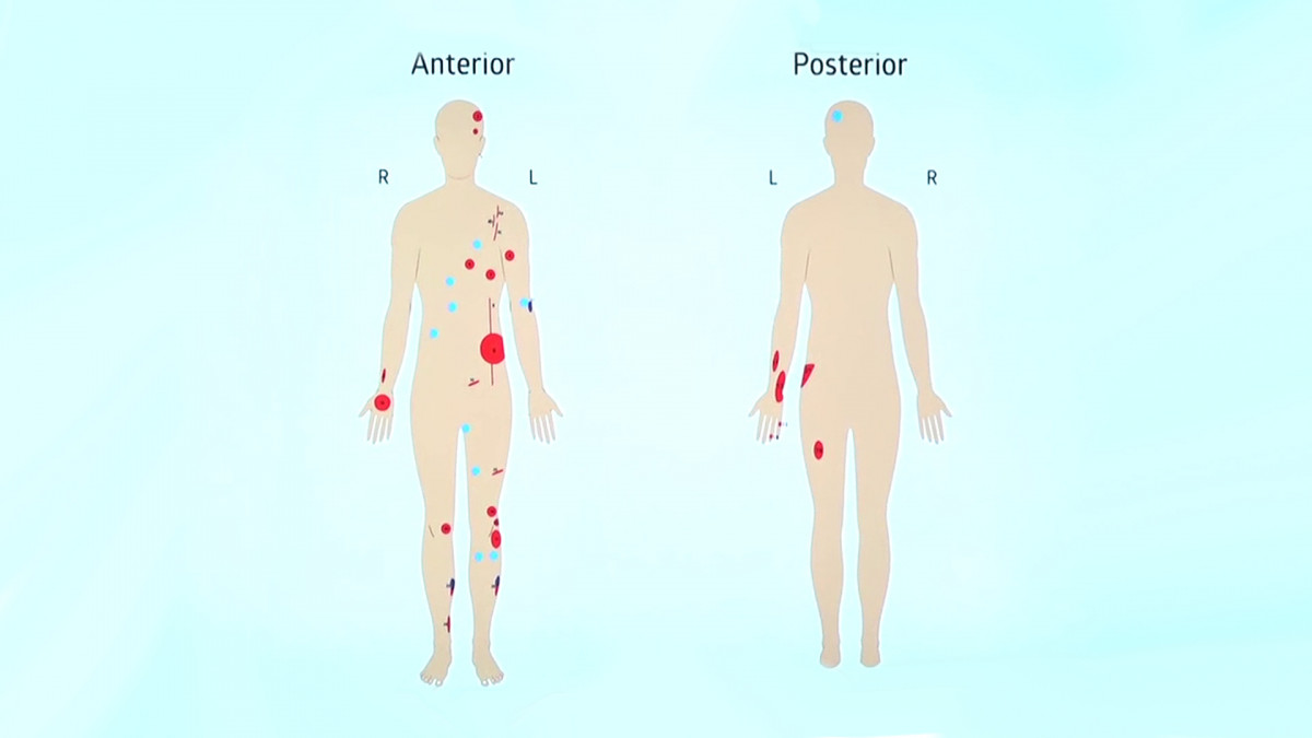 ADK Hospital publicizes a diagram showing the extent of Nasheed's injuries following Thursday's blast