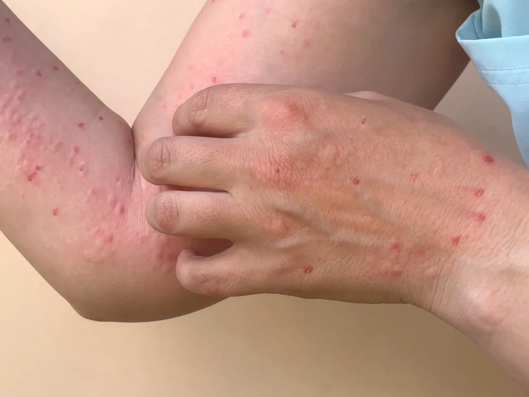 އެމްޕޮކްސް ޖެހިފައިވާ މީހެއް