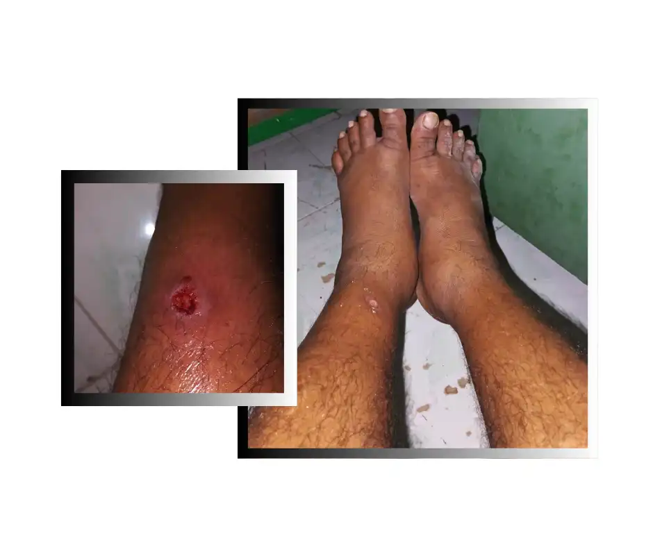 މާފުށީ ޖަލުގައި ހުރި ގައިދީއަކަށް ބޭސް ފަރުވާގެ ޚިދުމަތް ނުލިބި ބަލި ބޮޑުވަނީ