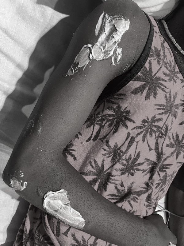 ދާންދޫގައި އީދު މަޅިޖެހުމުގެ ތެރޭގައި ޒުވާނެއްގެ އަތް ވަނީ ފިހިފައި