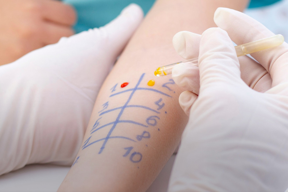 ސްކިން ޕްރިކް އެލާރޖީ ޓެސްޓިން އަދި އިމިއުނޮތެރަޕީގެ ޚިދުމަތް