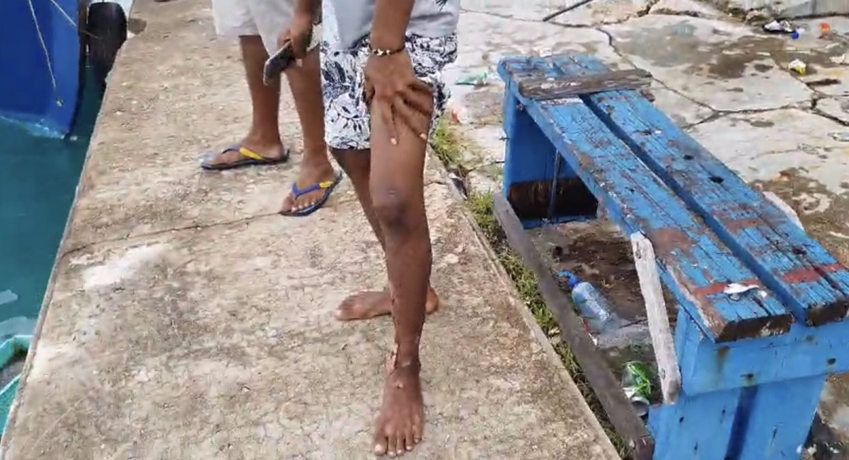 ވ. ތިނަދޫ ފަޅުގައި އަޅާފައި އޮތް ލޯންޗެއްގައި ރޯވެ މީހެއްގެ ފައި ފިހިފައި