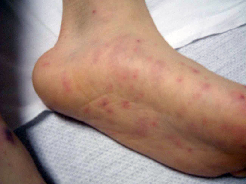 Meningococcal Disease